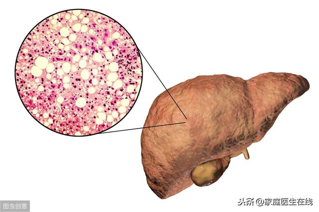 脂肪肝不是什麼大病？不及時治療，身體會遭受傷害